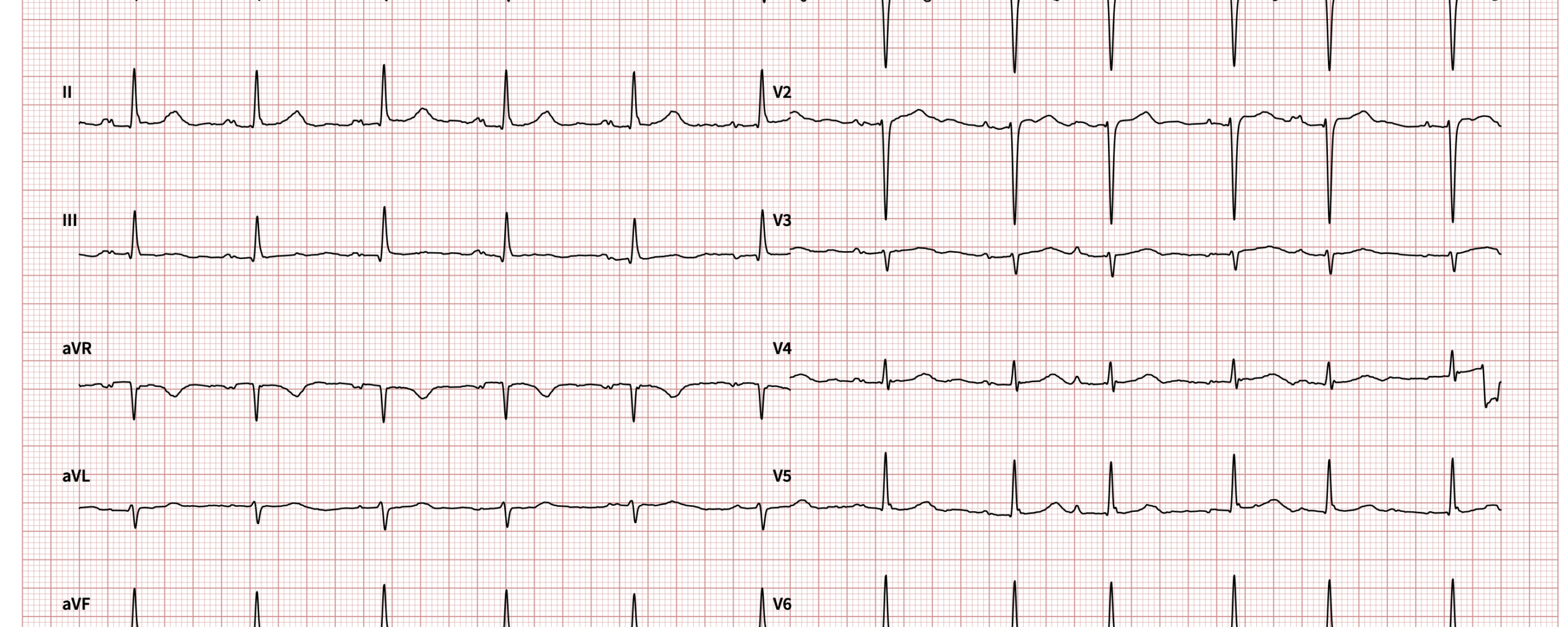 ECG 20-01-2026