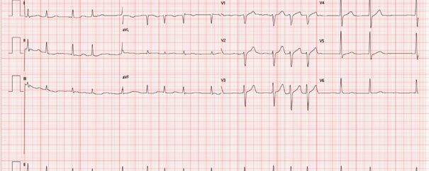 Afib