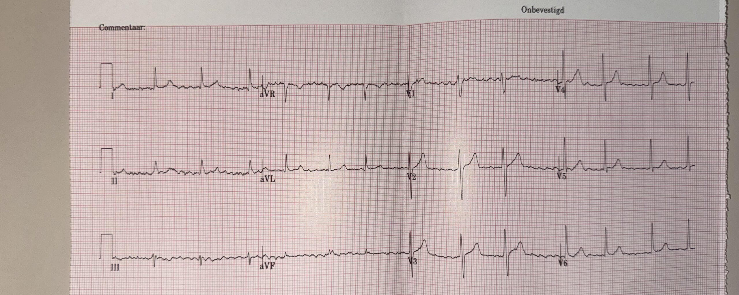 ECG SEH
