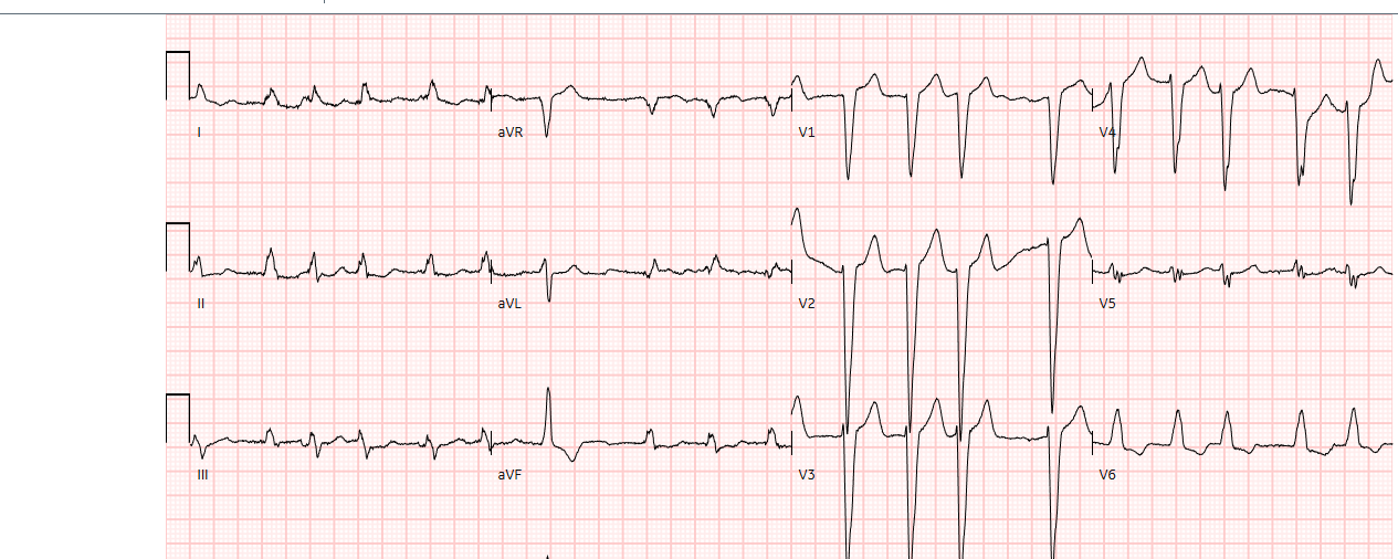 ECG interpretatie casus