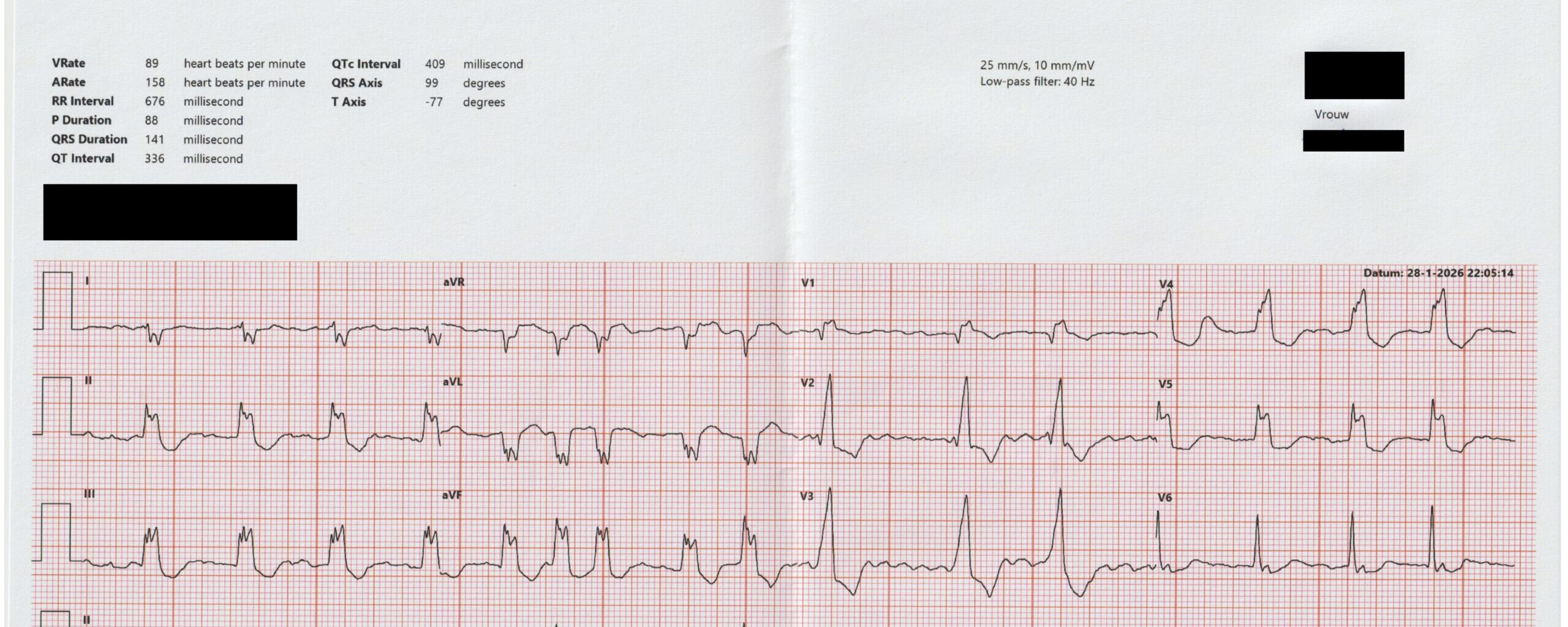 93-jarige patiente opgenomen op de SEH met dyspneuklachten. WD astma cardiale bij influenza A en recentelijk staken lisdiuretica.