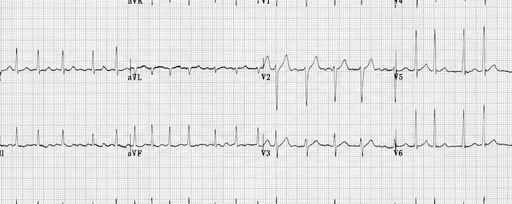 ECG oncologie patiënt