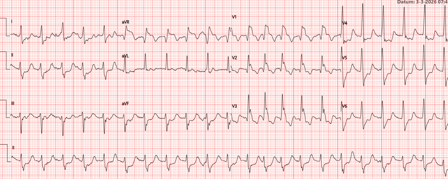 ECG terugkomdag 3 beschouwend
