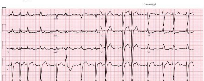 ECG acute nierinsufficiëntie