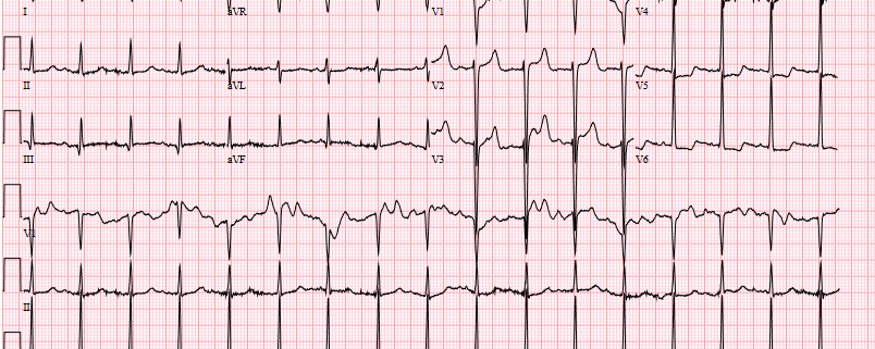 ECG